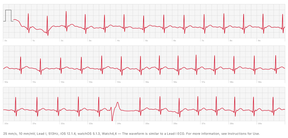 ecg-apple-watch